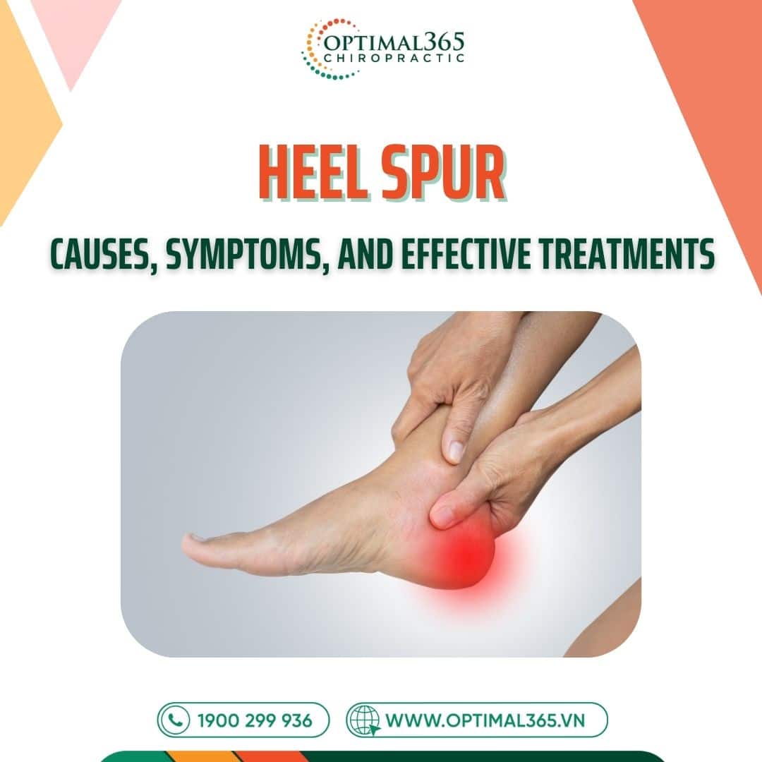 Understanding Heel Spur: Causes, Symptoms, and Effective Treatments