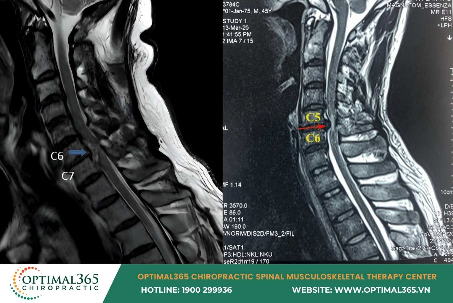 Cervical Herniated Disc