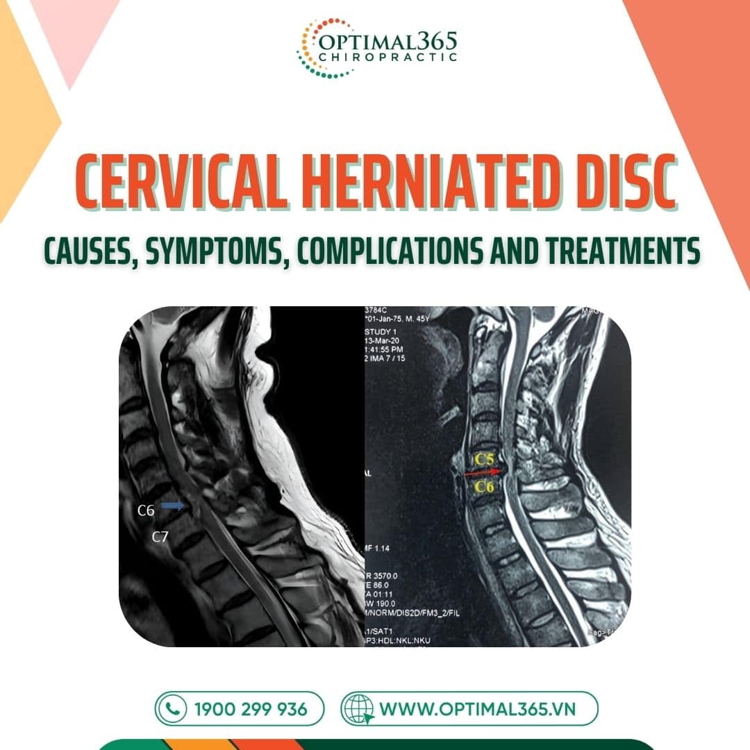Cervical Herniated Disc: Causes, Symptoms, Complications & Treatments