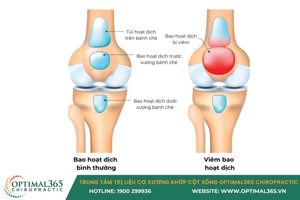 đau đầu gối ở người trẻ