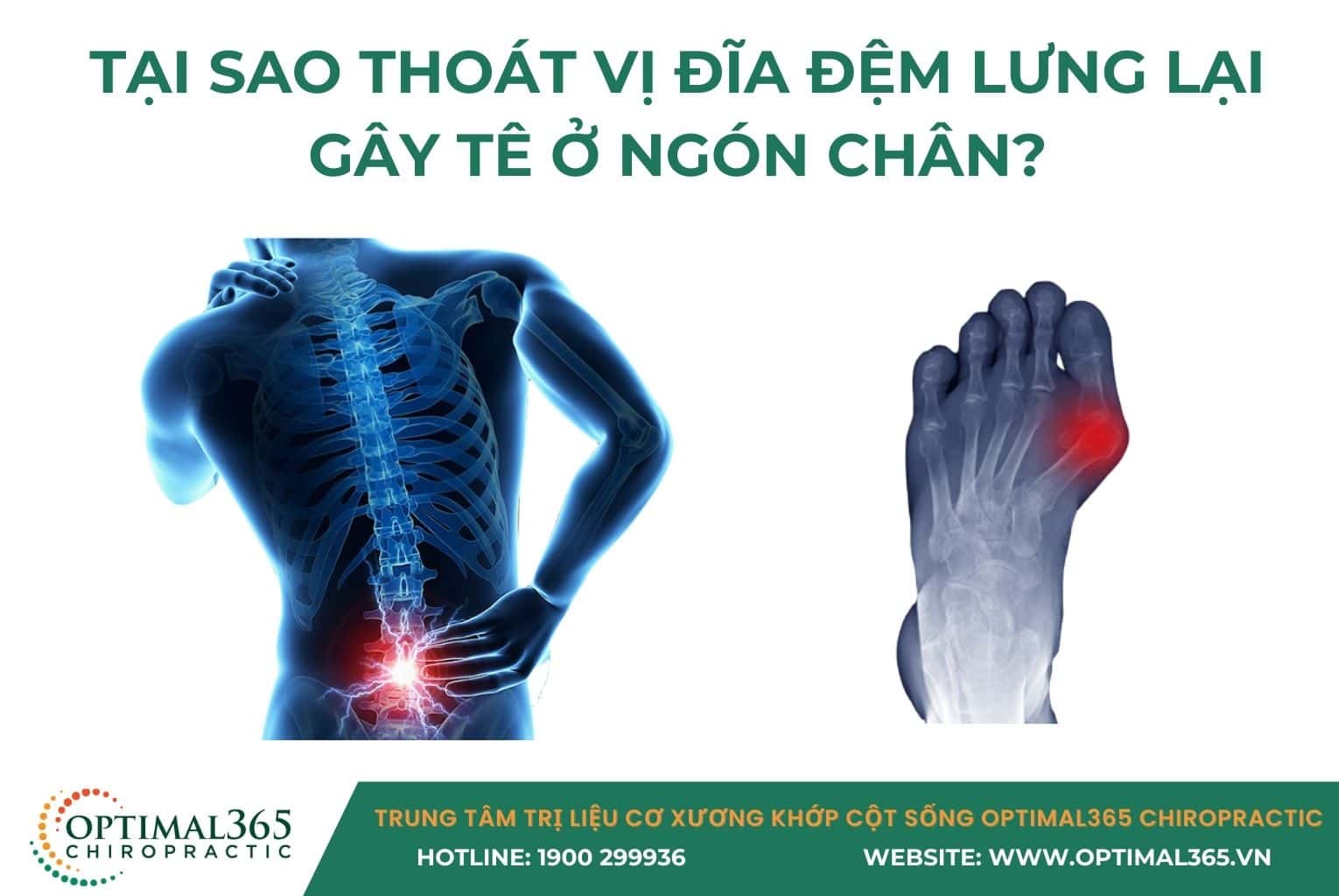 Tại sao thoát vị đĩa đệm lưng lại gây tê ở ngón chân?