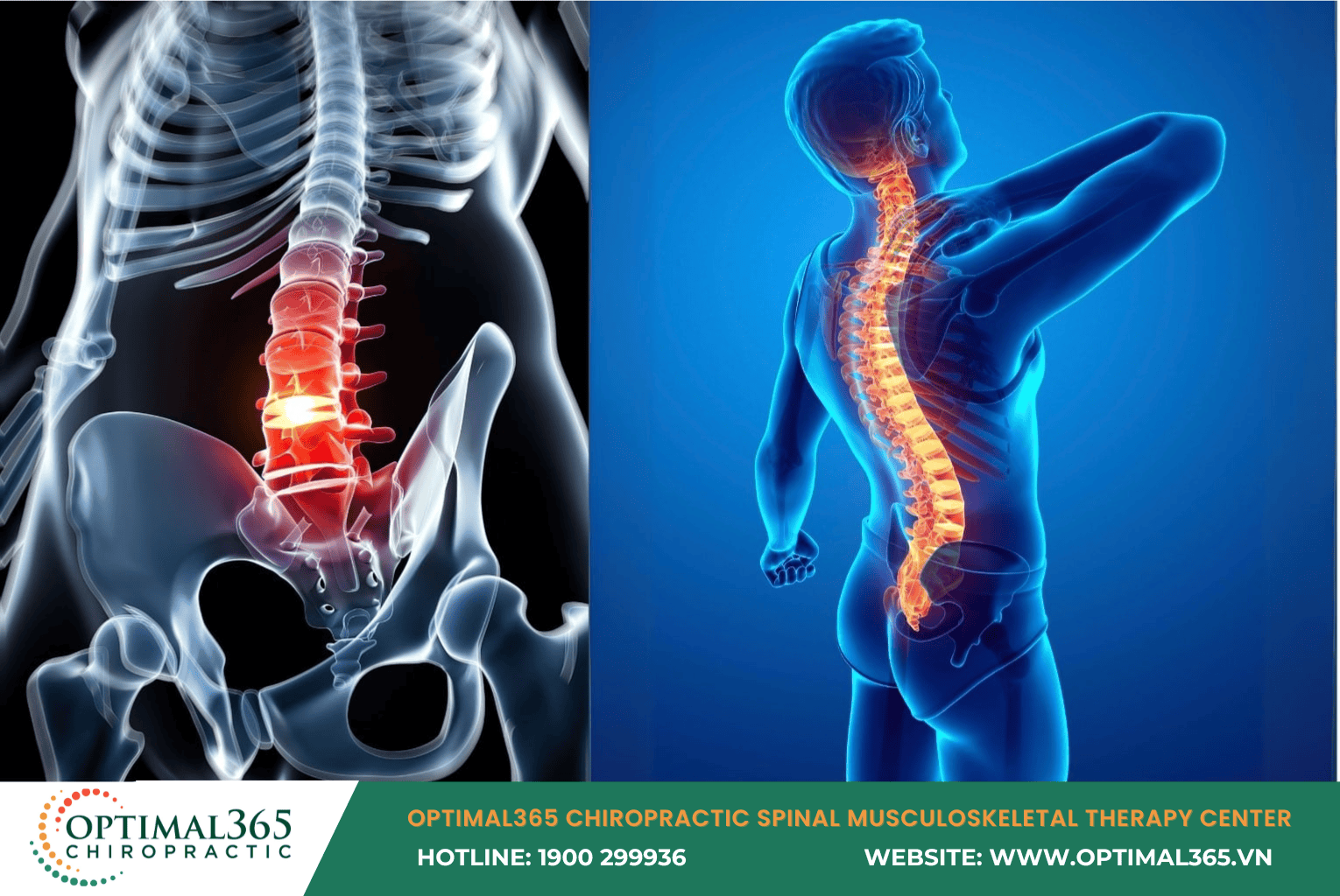 What Is a Herniated Disc?