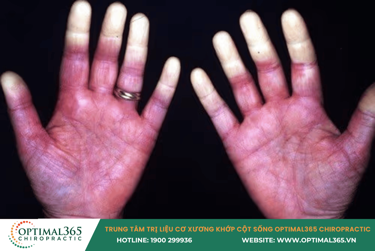 Rối loạn tuần hoàn (Raynaud)