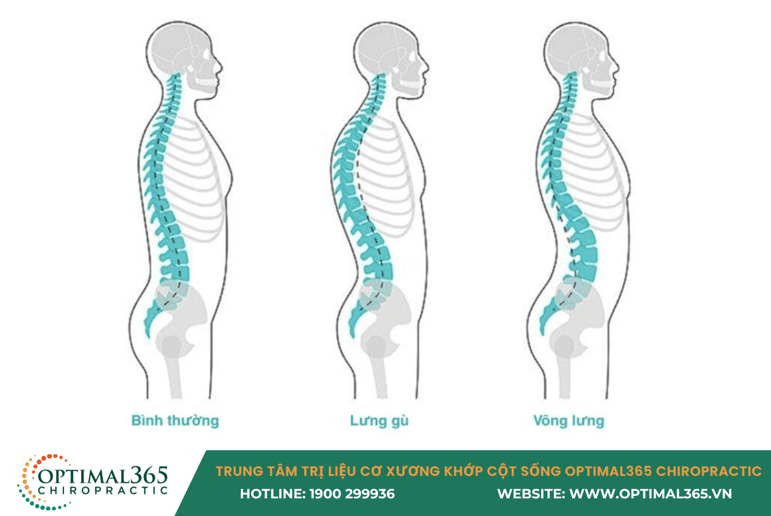 Dấu hiệu nhận biết võng lưng