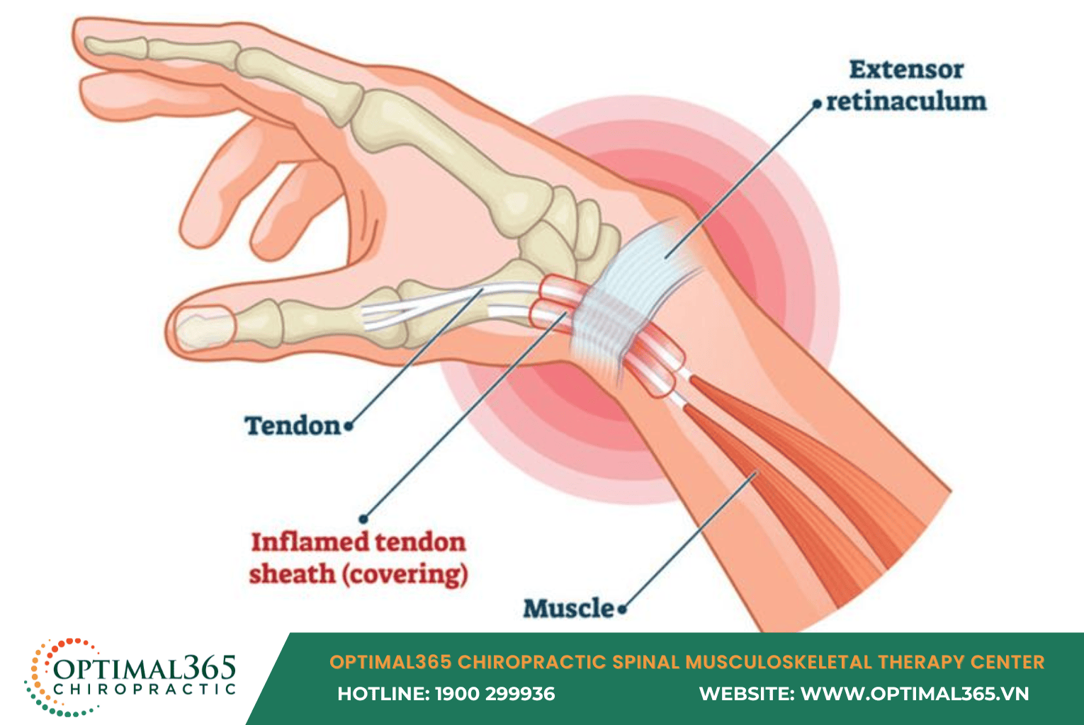 Wrist Tendonitis