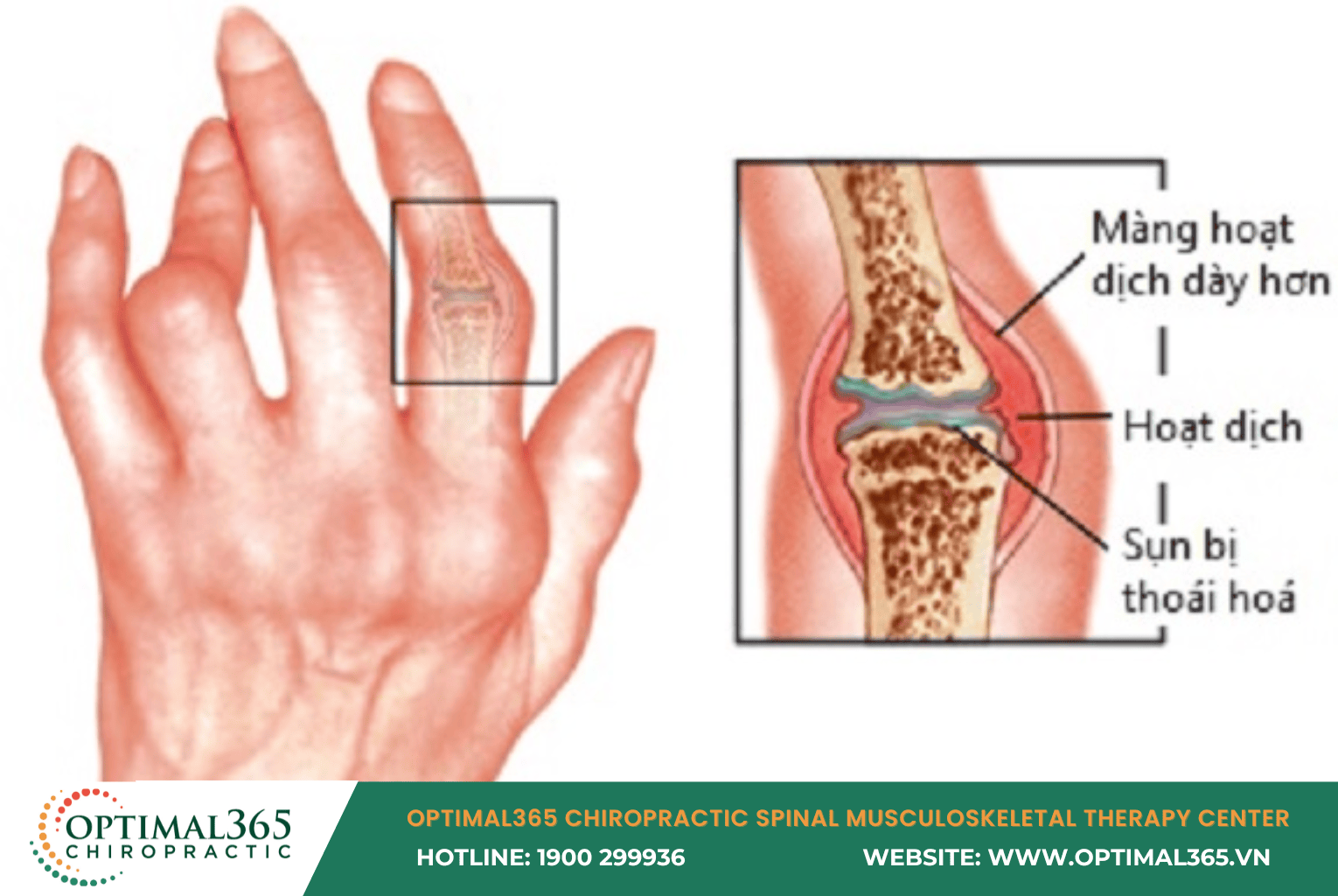 Arthritis or Wrist Joint Degeneration