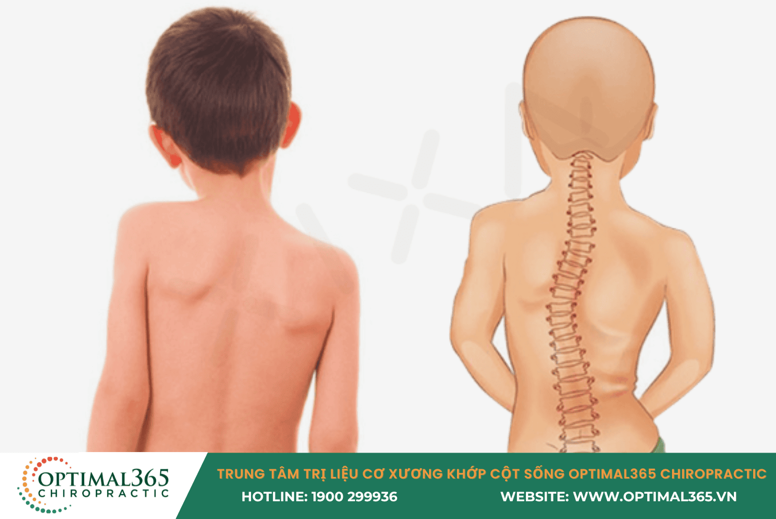 Tác hại của việc bỏ qua kiểm tra cột sống cho trẻ