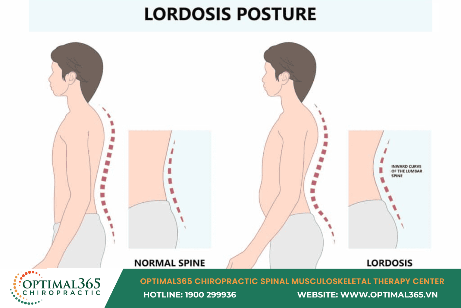 Minh họa võng lưng so với cột sống bình thường, tư thế ưỡn thắt lưng quá mứ